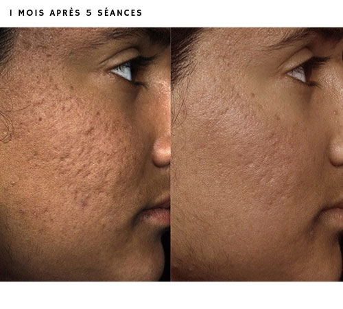 Résultats traitement laser cicatrices d'acné à Nantes - Dr Lasfargue