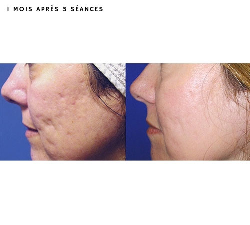 Résultats traitement laser cicatrices d'acné visage à Nantes - Dr Lasfargue