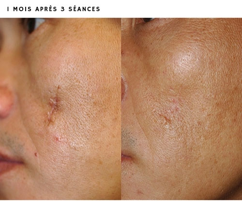 resultats-laser-fractionne-cicatrices-visage-nantes-dr-lasfargue